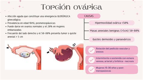 Diagrama anatómico de los anexos femeninos con indicación de torsión ovárica