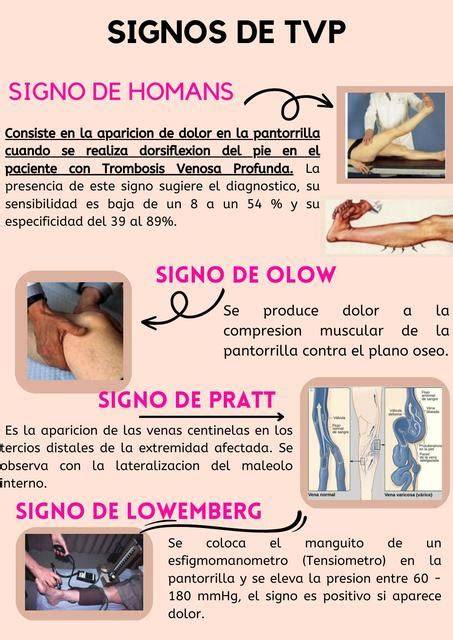 Ilustración de una pierna con signos de TVP, como hinchazón y enrojecimiento