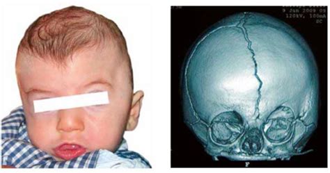 Bebé con cráneo agrandado, señalando la posible presencia de un feto en desarrollo dentro de su cabeza.