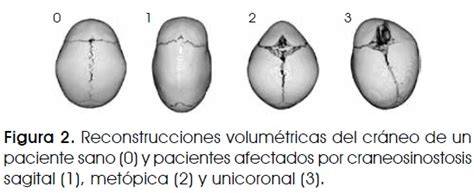 Ejemplos de formas craneales anormales por craneosinostosis