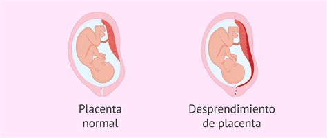 Ilustración de desprendimiento de placenta y rotura uterina
