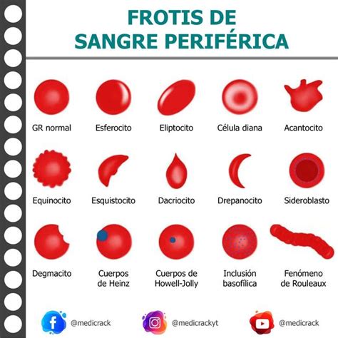Micrografía de un frotis de sangre periférica mostrando diferentes tipos de leucocitos y sus morfologías.
