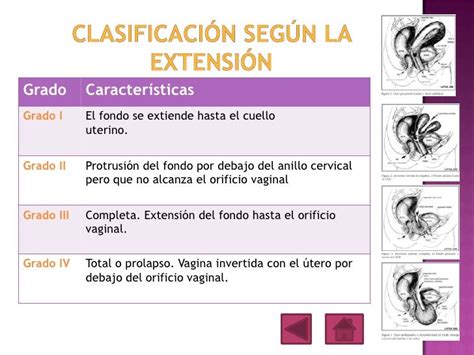 Ilustración de los grados de inversión uterina