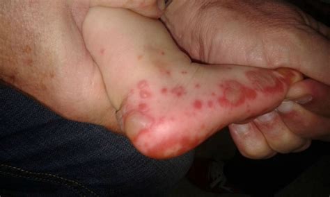 Foto: Erupción de pústulas sobre base eritematosa de predominio troncal en neonato