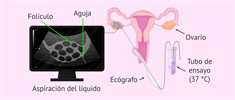 Esquema de punción ovárica guiada por ecografía transvaginal