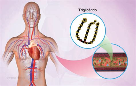 Infografía: Complicaciones materno-fetales de la hipertrigliceridemia severa en la gestación