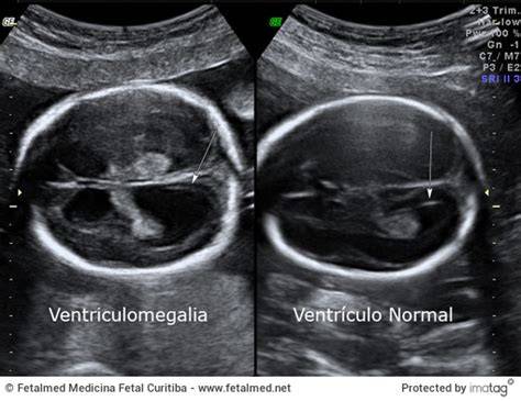Ecografía fetal mostrando ventrículos cerebrales dilatados (ventriculomegalia)