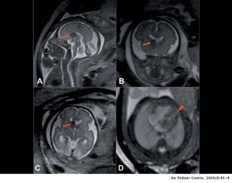 Resonancia Magnética fetal detallando anomalías cerebrales