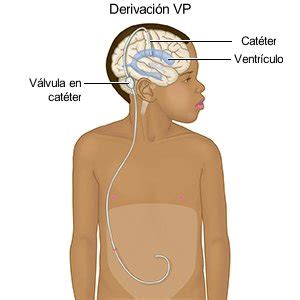 Diagrama de colocación de derivación ventrículo-peritoneal para tratar hidrocefalia