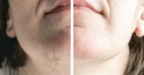 Foto de una paciente con hirsutismo facial