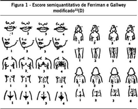 Tabla con la escala de Ferriman-Gallwey modificada para cuantificar el hirsutismo