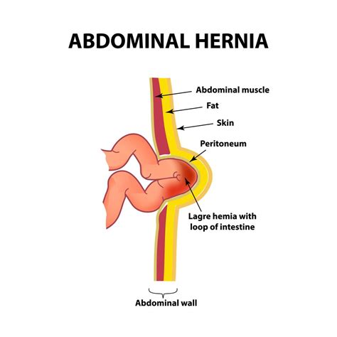 diagrama que muestra la anatomía de una hernia umbilical