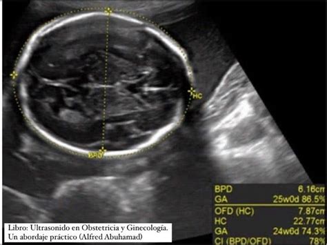 Gráfico que muestra los parámetros biométricos fetales (circunferencia cefálica, abdominal, longitud del fémur) en diferentes semanas de gestación.