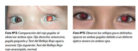Foto comparativa de reflejo rojo pupilar normal vs. leucocoria