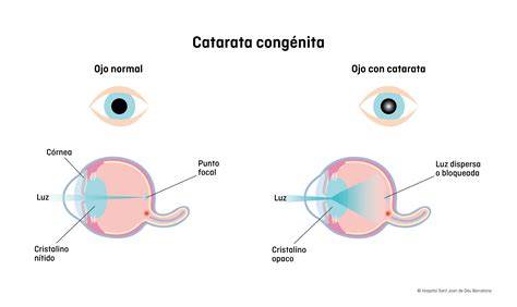 Ilustración de un ojo con catarata congénita