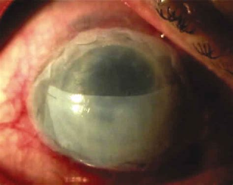 Ilustración de la aplicación de un injerto de membrana amniótica en un ojo con defecto corneal
