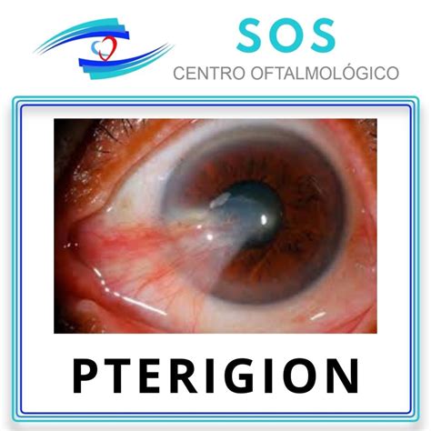Fotografía comparativa de un ojo con pterigión y otro tratado con injerto de membrana amniótica