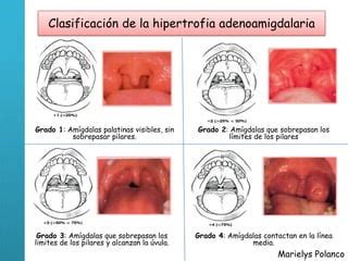 Infografía: Clasificación de la hipertrofia de amígdalas y adenoides