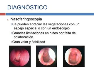 Imagen ilustrativa de una nasofaringoscopia pediátrica