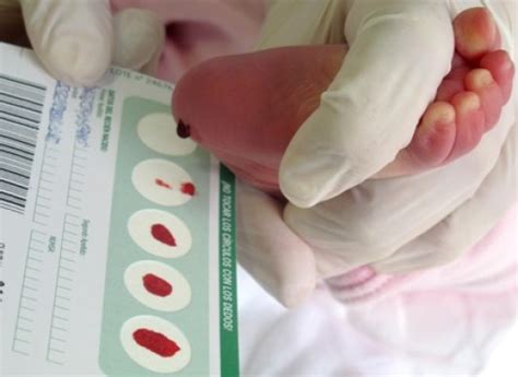 Foto de la prueba del talón en un bebé, mostrando la lanceta y el papel secante para la muestra