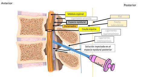Esquema anatómico mostrando el espacio epidural y espinal para la administración de anestesia neuroaxial.