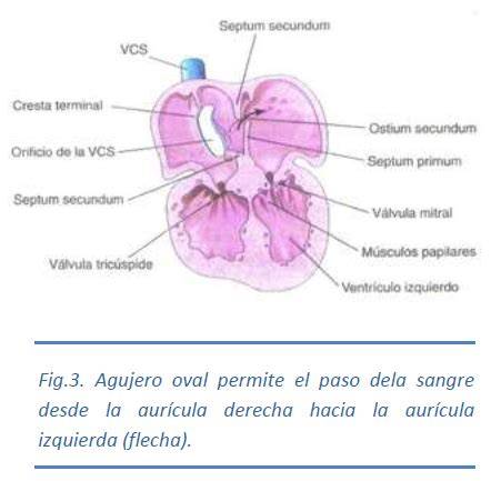 Ilustración de la tabicación auricular, mostrando el crecimiento del septum primum y la formación del ostium secundum.