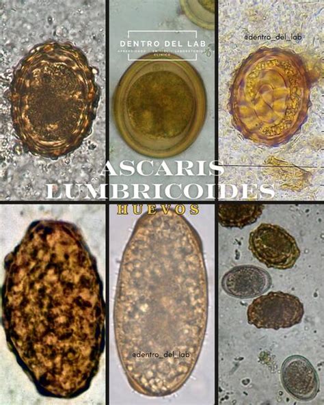 Microfotografía mostrando los diferentes tipos de huevos de Ascaris lumbricoides: fértiles, infértiles y decorticados.