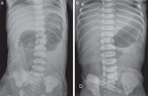 Imagen de un estudio radiológico de abdomen que muestra la presencia de un Ascaris lumbricoides en el intestino.