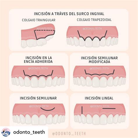 Infografía comparando la incisión de un colgajo tradicional con la incisión de la técnica EPPT