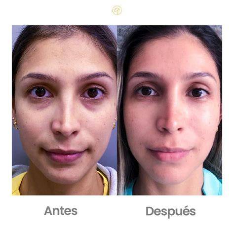 Fotografías clínicas de antes y después de un tratamiento con EPPT mostrando la resolución del defecto y la estabilidad a largo plazo