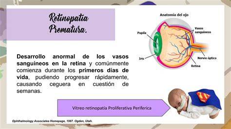 Infografía mostrando el desarrollo anormal de vasos sanguíneos en la retina en ROP.