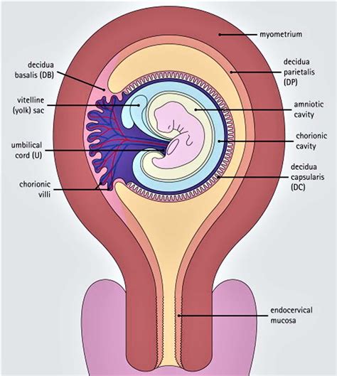 Esquema anatómico mostrando la invasión trofoblástica más allá de la decidua en comparación con una placenta normal.