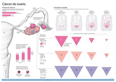 Infografía sobre los estadios del cáncer de ovario desde el estadio I al IV.