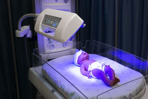 Bebé recibiendo fototerapia con protección ocular