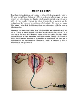 Infografía: Mecanismo de la atonía uterina y el Balón de Bakri