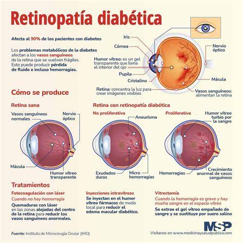 Infografía: Tipos de retinopatía diabética