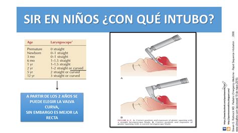 Técnica de intubación en lactantes y niños