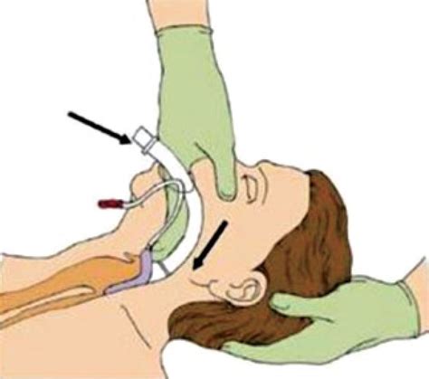 Colocación de la mascarilla laríngea