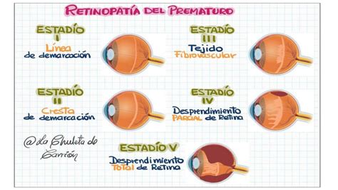 Esquema de la retinopatía del prematuro (ROP)
