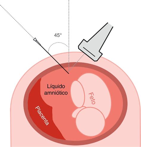 Esquema de la amniocentesis mostrando la aguja insertándose en el saco amniótico bajo guía ecográfica