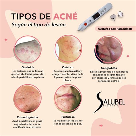 Comparación visual de diferentes tipos de lesiones de acné y cicatrices.