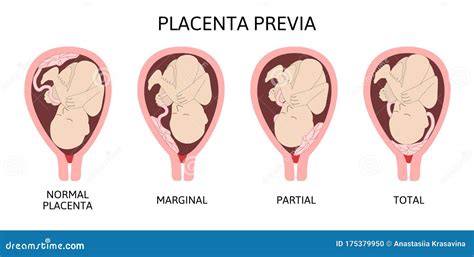 Esquema de las diferentes posiciones de la placenta en la placenta previa: normal, marginal, parcial y total.