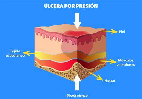 Esquema de las úlceras por presión y sus causas principales