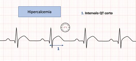 Esquema del electrocardiograma mostrando las alteraciones típicas asociadas a la hipercalcemia.