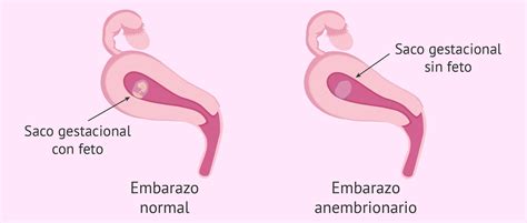 Esquema ilustrativo del saco gestacional y la ausencia de embrión en un embarazo anembrionario frente a un embarazo normal
