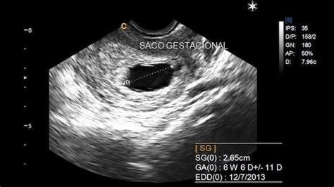 Ecografía transvaginal mostrando un saco gestacional vacío (huevo huero) en el primer trimestre