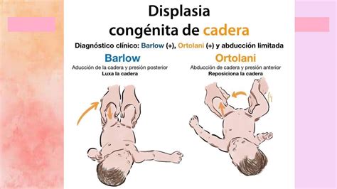 Ilustración de las maniobras de Ortolani y Barlow para la detección de displasia de cadera