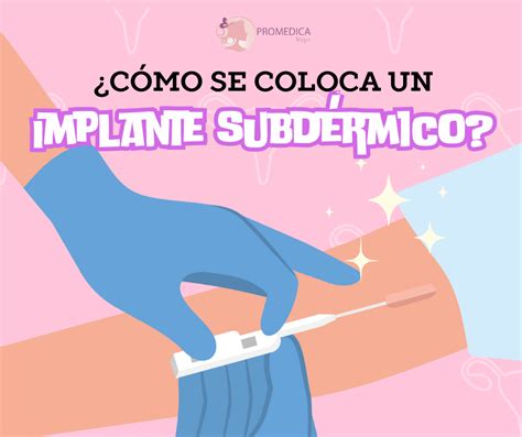 Esquema de la localización y extracción de un implante anticonceptivo subdérmico.