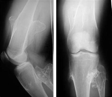 Radiografía de múltiples osteocondromas en extremidades inferiores de un niño