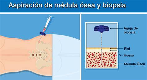 Ilustración del procedimiento de aspiración y biopsia de médula ósea